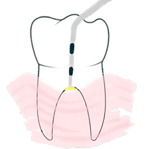 Glickman Classification (1953) Class I