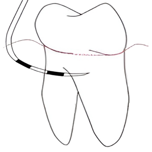 Hamp Classification (1975) Class I