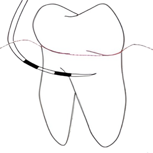 Hamp Classification (1975) Class II