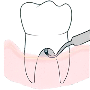 Glickman Classification (1953) Class III