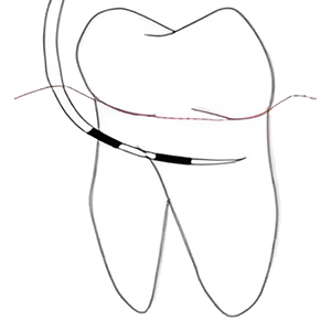 Hamp Classification (1975) Class III