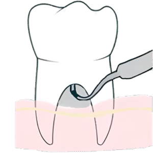 Glickman Classification (1953) Class IV